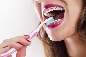 Tem aparelho nos dentes? Saiba como cuidar da saúde da boca!