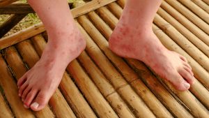 Mitos e verdades sobre o sarampo