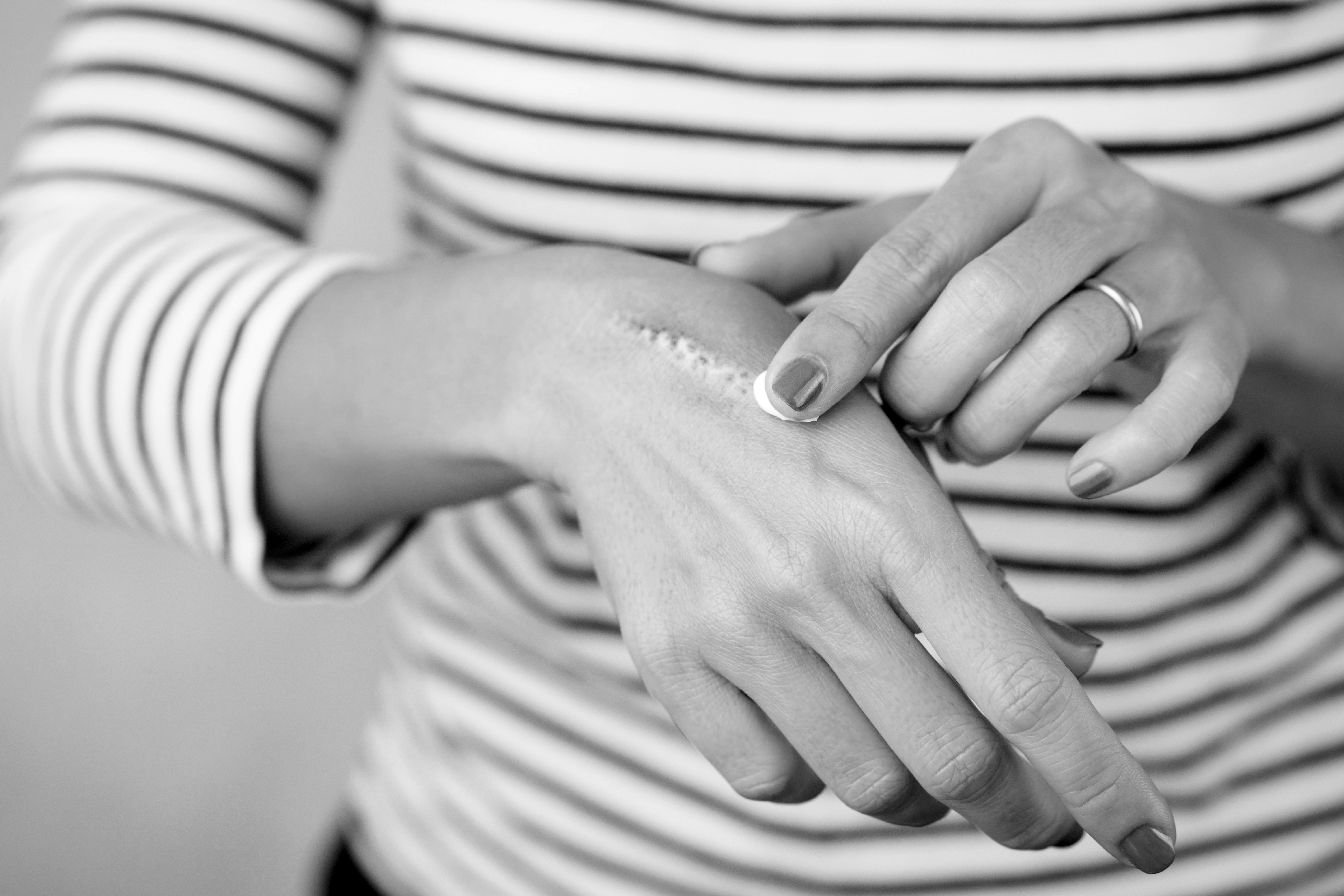 Saiba o que fazer ao sofrer uma queimadura!